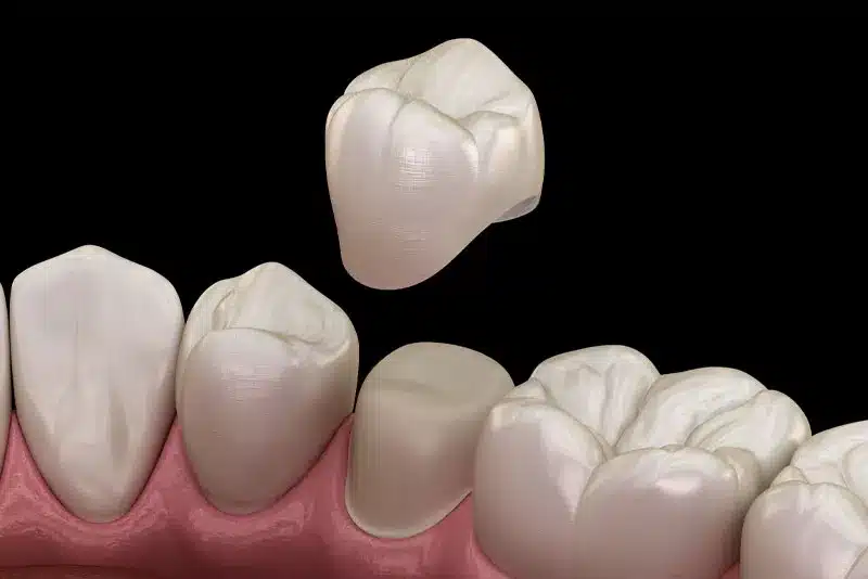 With CEREC same-day crowns, we can design, create, and place your crown all in the same visit.